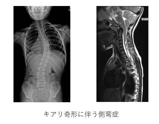 症候性側弯症