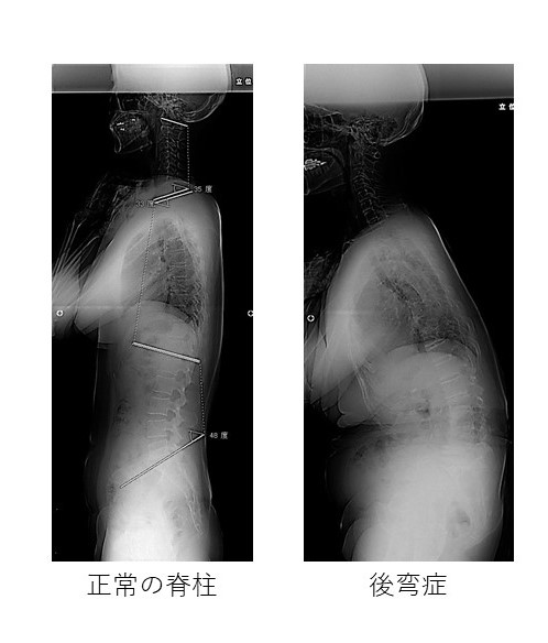 側弯症について②