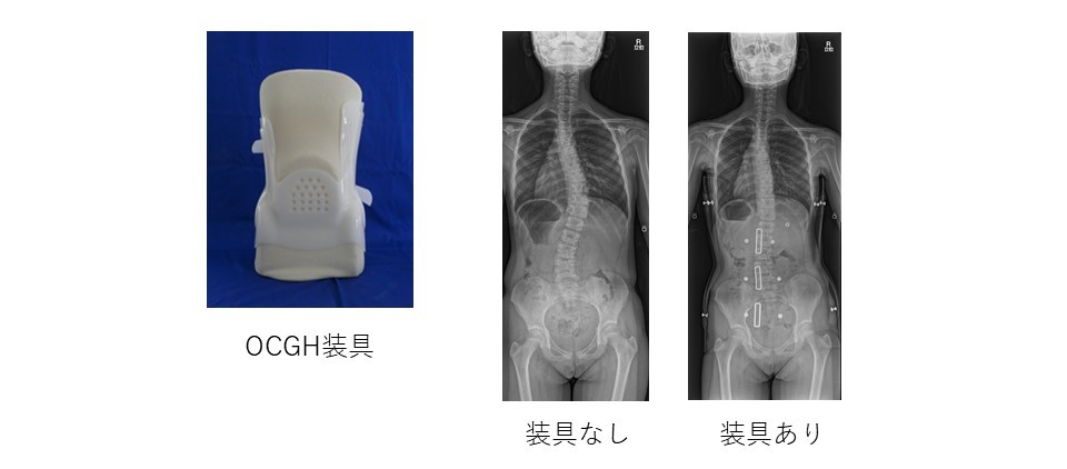 装具治療