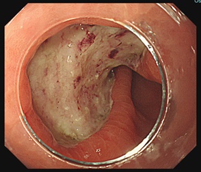 Ulcer after resection 