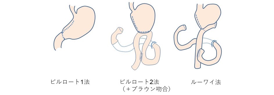 幽門側胃切除後再建法