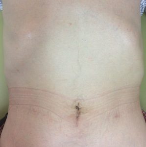 ダヴィンチ手術後1年の創部（胃）