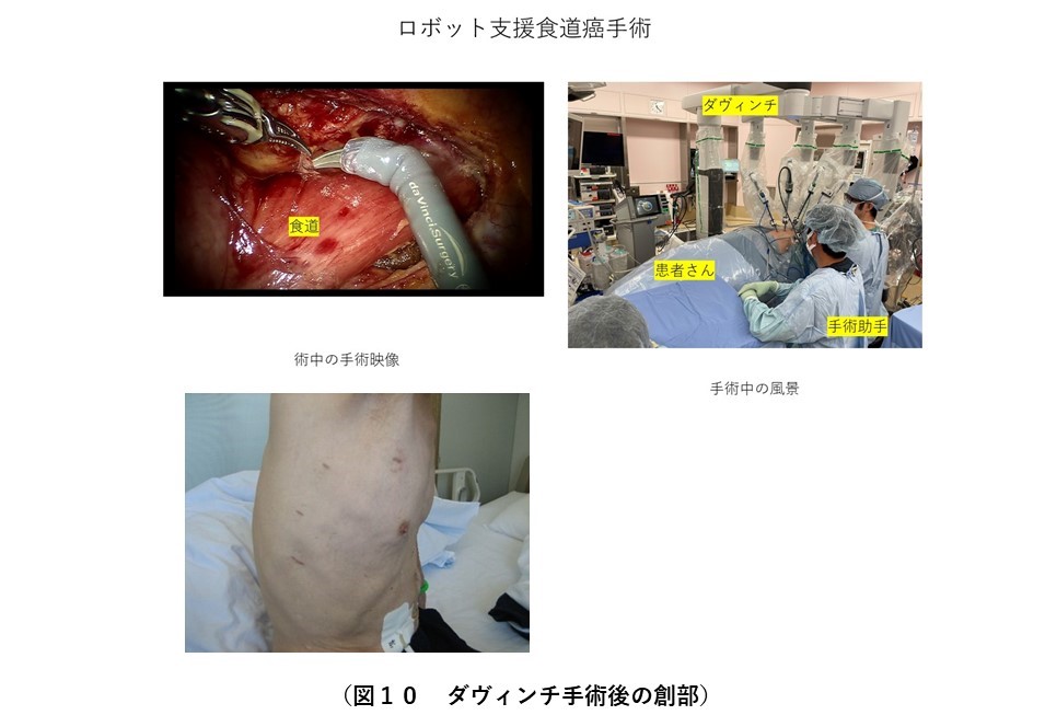図１０ダヴィンチ手術後の創部