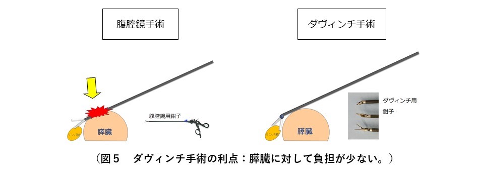 図５　ダヴィンチ手術の利点