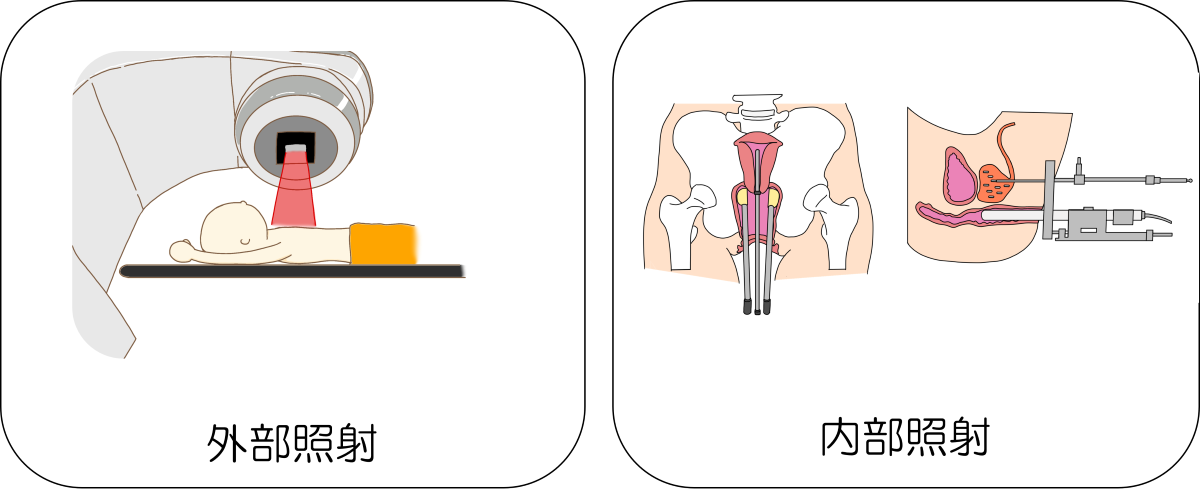 外部照射・内部照射