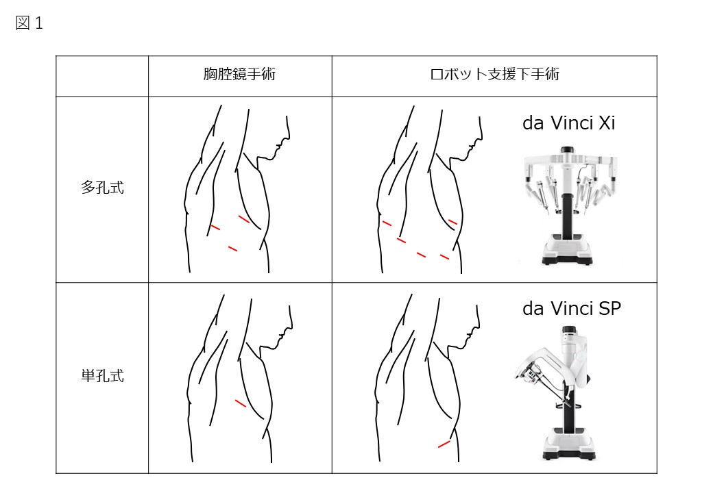 呼吸器外科　図１